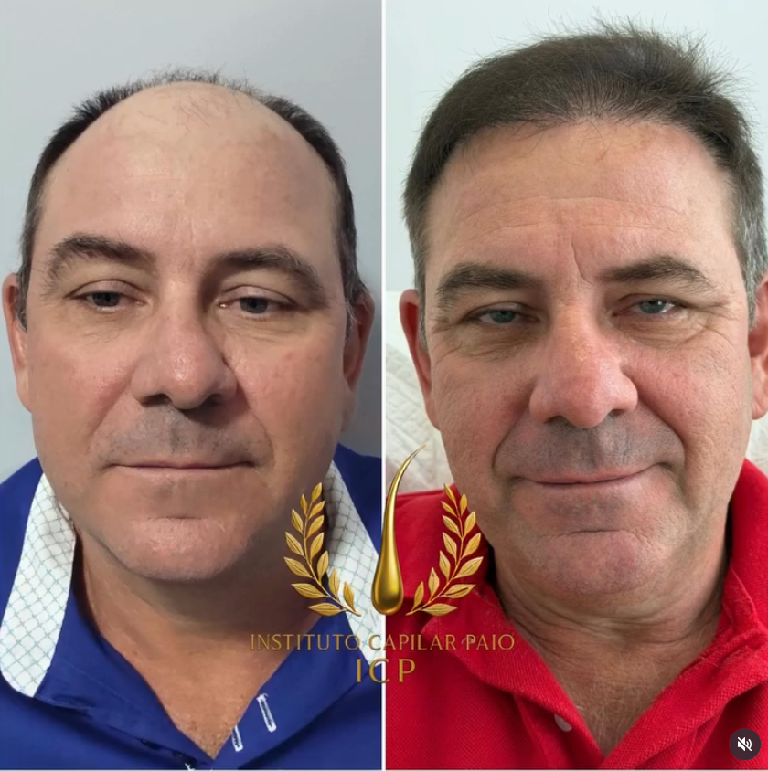 Comparação de antes e depois de evolução capilar, caso 1