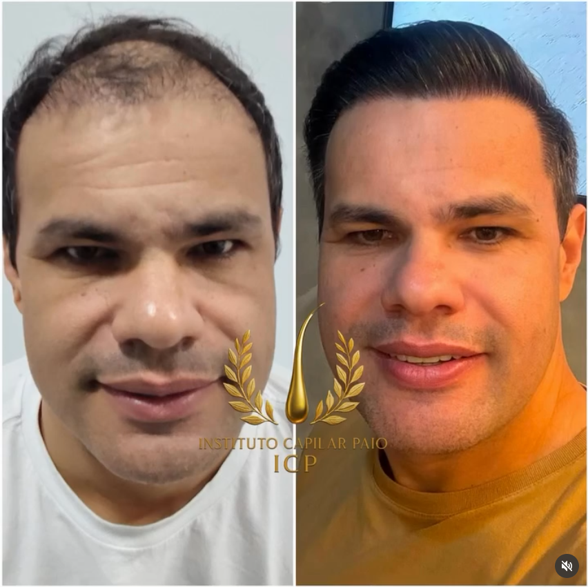 Comparação de antes e depois de evolução capilar, caso 2