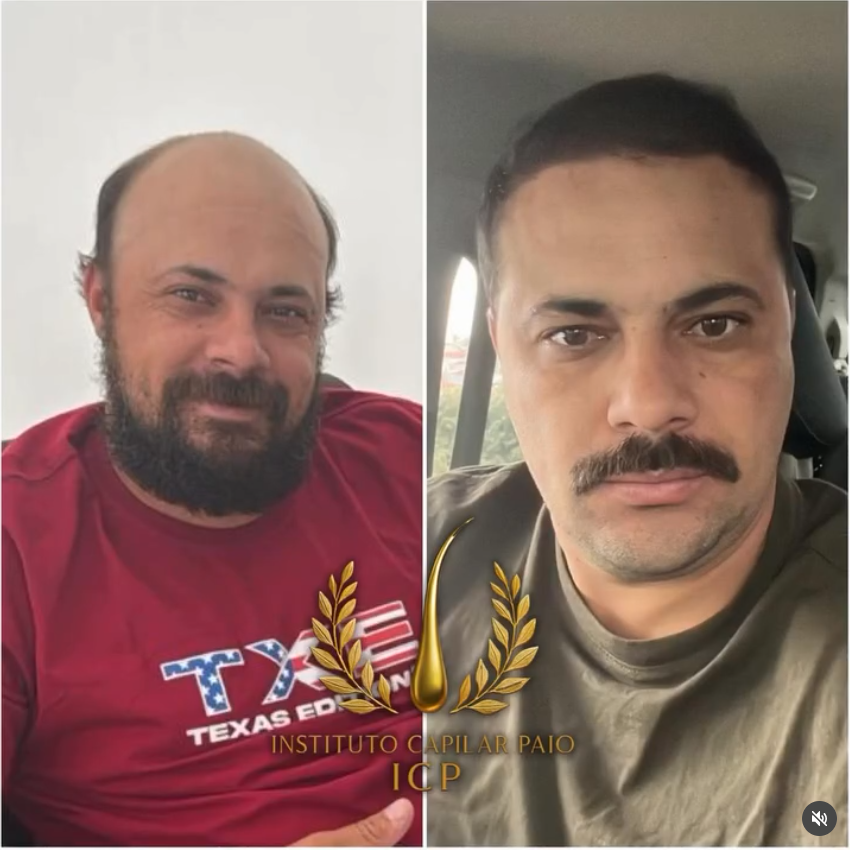 Comparação de antes e depois de evolução capilar, caso 3